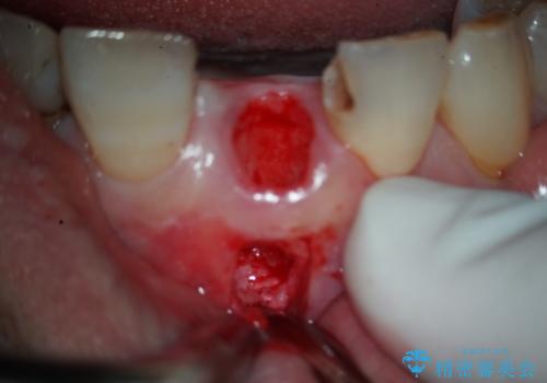 折れた前歯を即時インプラントで回復の治療中
