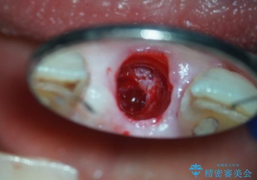 折れた前歯を即時インプラントで回復の治療中