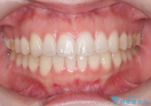 八重歯と口元のバランスを整えた矯正治療の治療後