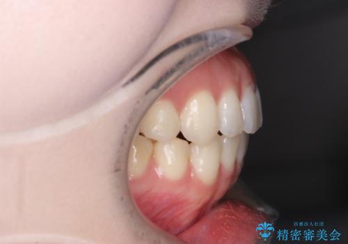 抜歯せずに八重歯を解消!アンカースクリューで実現した奥歯の移動の治療後