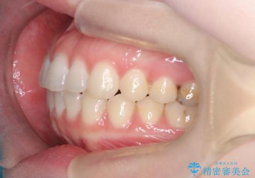 抜歯せずに八重歯を解消!アンカースクリューで実現した奥歯の移動の治療後