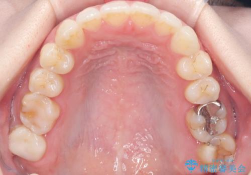 抜歯せずに八重歯を解消!アンカースクリューで実現した奥歯の移動の治療後