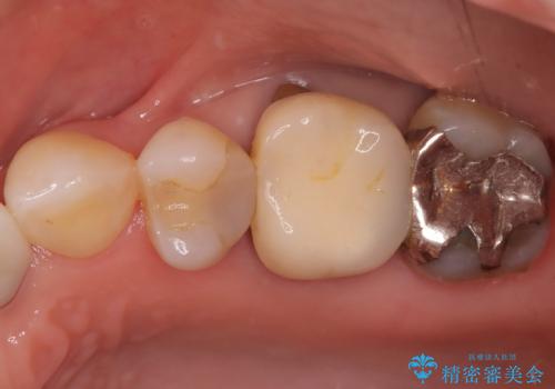 虫歯と古い被せ物をきれいに修復の治療前