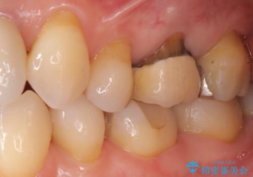 虫歯と古い被せ物をきれいに修復の治療前
