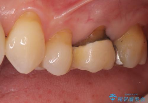 虫歯と古い被せ物をきれいに修復の治療前
