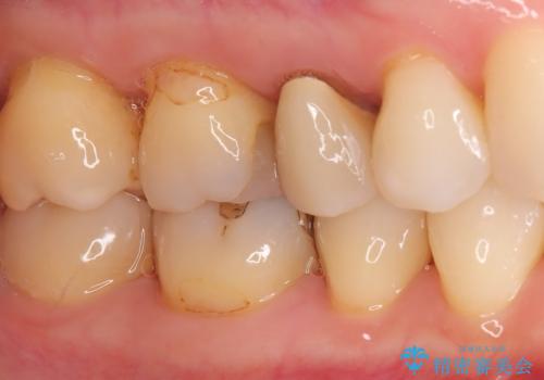 古い被せ物の中のむし歯を治療の治療前
