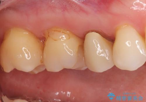古い被せ物の中のむし歯を治療の治療前