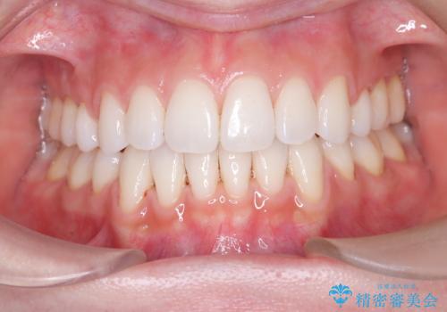 口元と八重歯を整えたワイヤー矯正の治療後