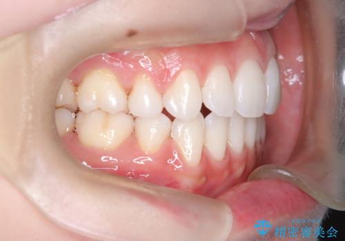 口元と八重歯を整えたワイヤー矯正の治療後