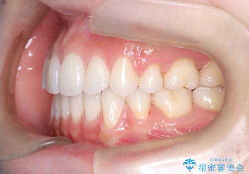 口元と八重歯を整えたワイヤー矯正の治療後