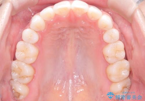 口元と八重歯を整えたワイヤー矯正の治療後