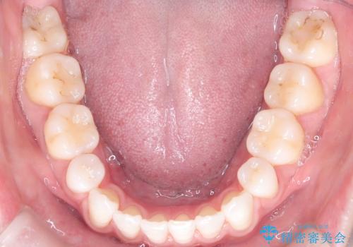 口元と八重歯を整えたワイヤー矯正の治療後