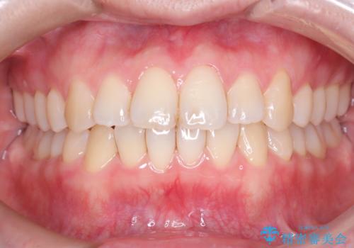 前歯の出っ張りをマウスピースで改善の症例 治療後