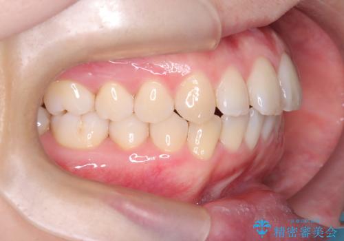 前歯の出っ張りをマウスピースで改善の治療後