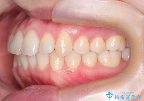前歯の出っ張りをマウスピースで改善の治療後