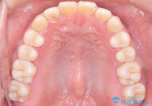 前歯の出っ張りをマウスピースで改善の治療後