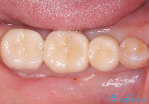 目立つ銀歯を白く自然な歯に改善