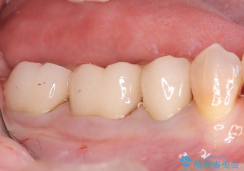 目立つ銀歯を白く自然な歯に改善の治療後