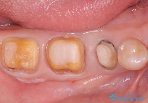 目立つ銀歯を白く自然な歯に改善の治療中