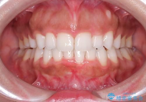 前歯の出っ張りとガタつきを改善の治療後