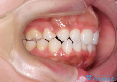 前歯の出っ張りとガタつきを改善の治療後