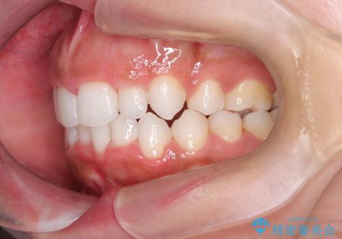 前歯の出っ張りとガタつきを改善の治療後