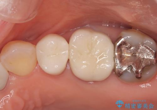 虫歯と古い被せ物をきれいに修復の治療後