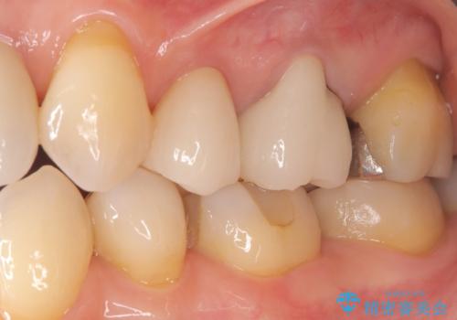 虫歯と古い被せ物をきれいに修復の治療後