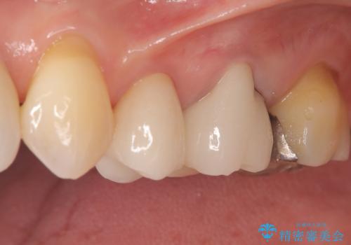 虫歯と古い被せ物をきれいに修復の治療後