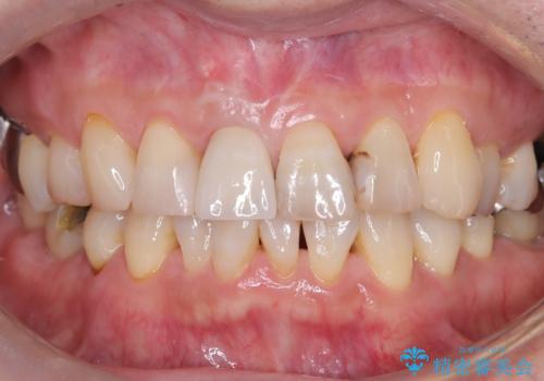 折れた前歯を即時インプラントで回復の症例 治療後