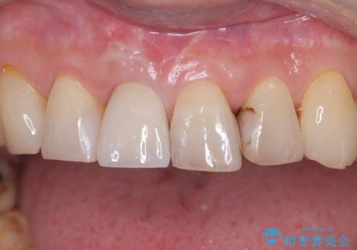 折れた前歯を即時インプラントで回復の治療後