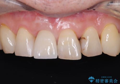 折れた前歯を即時インプラントで回復の治療後