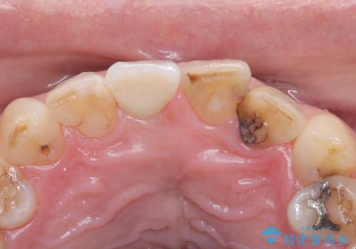 折れた前歯を即時インプラントで回復の治療後