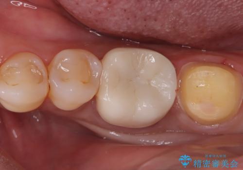 割れた奥歯をセラミックで修復の治療中