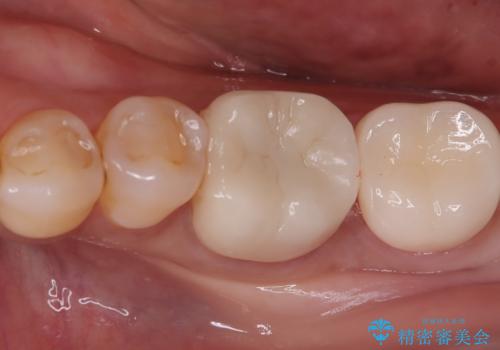 割れた奥歯をセラミックで修復の治療後