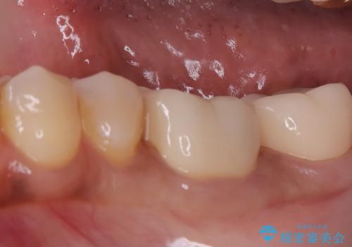 割れた奥歯をセラミックで修復の治療後