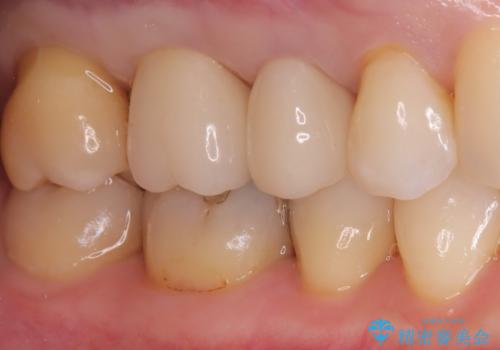 古い被せ物の中のむし歯を治療