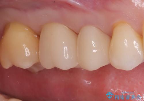 古い被せ物の中のむし歯を治療の治療後