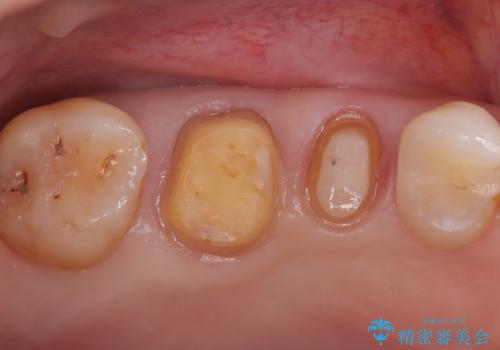 古い被せ物の中のむし歯を治療の治療中