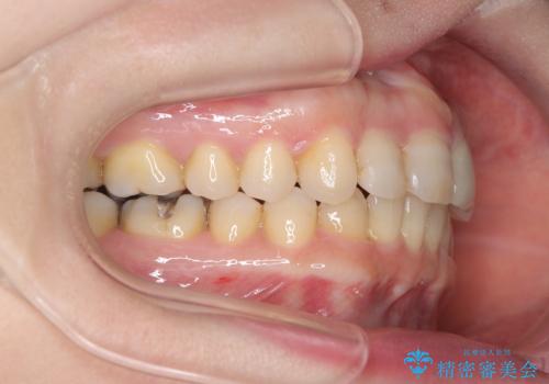 八重歯と口元のバランスを整えた矯正治療の治療後
