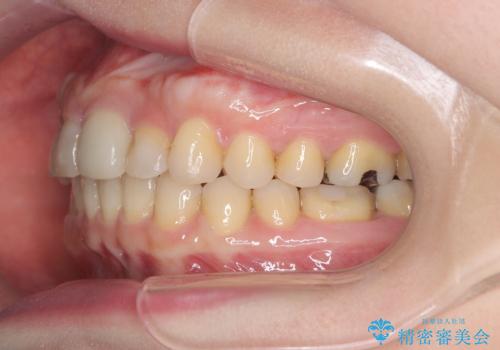 八重歯と口元のバランスを整えた矯正治療の治療後