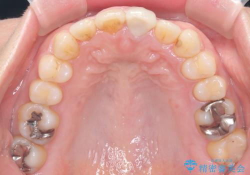 八重歯と口元のバランスを整えた矯正治療の治療後