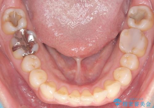 八重歯と口元のバランスを整えた矯正治療の治療後