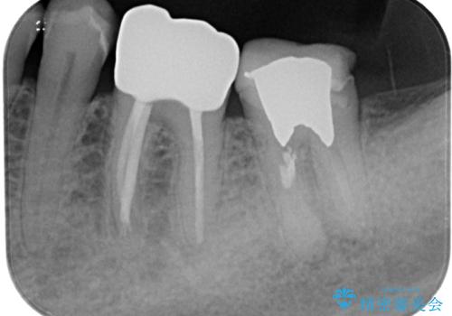 下顎大臼歯の再根管治療とオールセラミッククラウンによる補綴治療の治療前