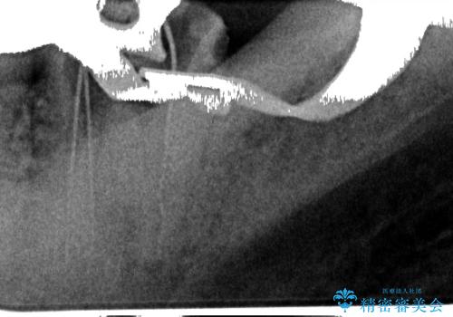 下顎大臼歯の再根管治療とオールセラミッククラウンによる補綴治療の治療中