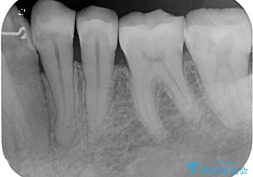 何もしなくても歯がズキズキ痛い 根管治療とオールセラミッククラウンによる補綴の治療前