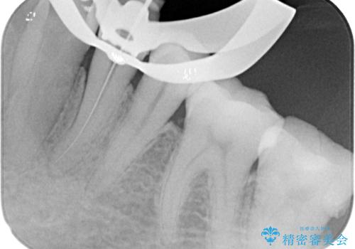 何もしなくても歯がズキズキ痛い 根管治療とオールセラミッククラウンによる補綴の治療中