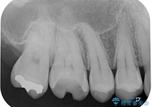 銀歯が外れた。オールセラミッククラウンによる補綴治療の治療前