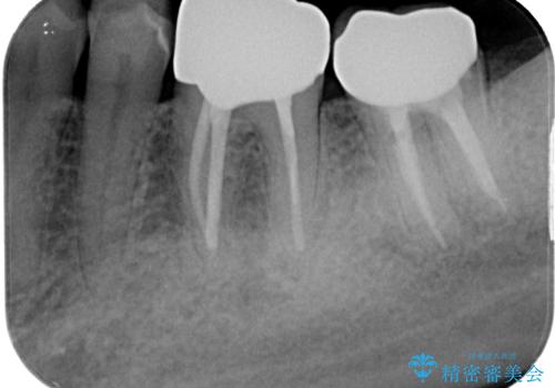下顎大臼歯の再根管治療とオールセラミッククラウンによる補綴治療の治療後