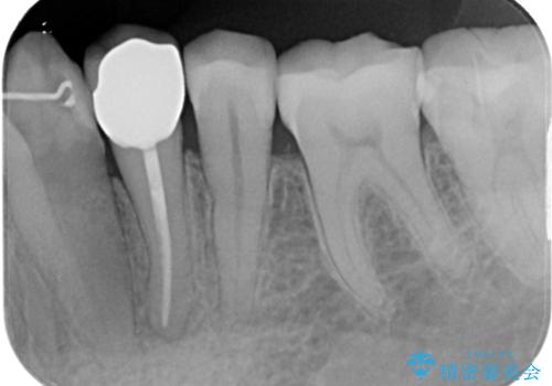 何もしなくても歯がズキズキ痛い 根管治療とオールセラミッククラウンによる補綴の治療後